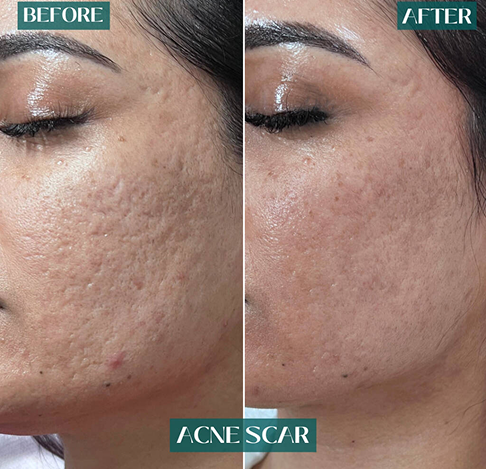 Acne scar treatment: original before photograph on the left and after on the right